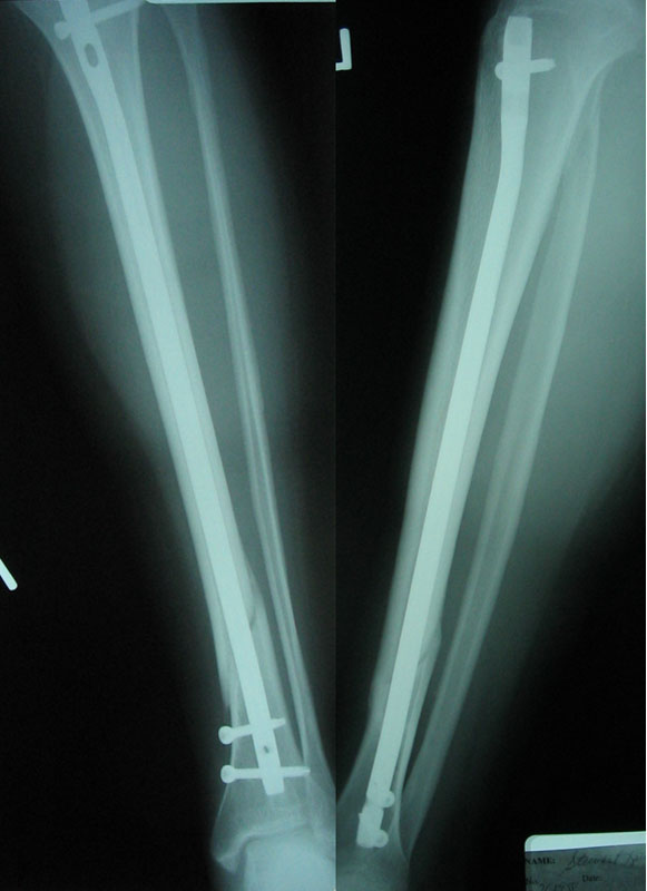 broken leg x ray. I finally got an x-ray of the